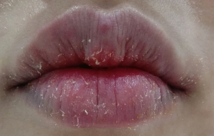 嘴唇上的皮肤病有哪些图片