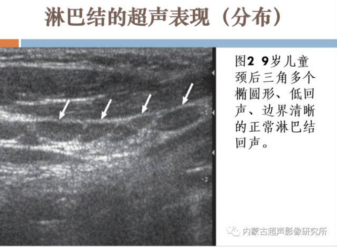 儿童颈部淋巴结超声表现