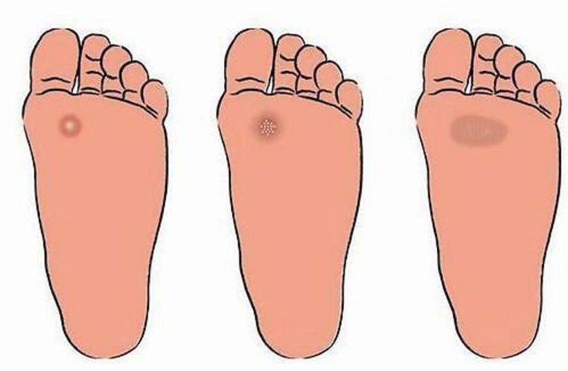 糖尿病在出现烂脚之前有什么早期的症状没有 健康号 微医