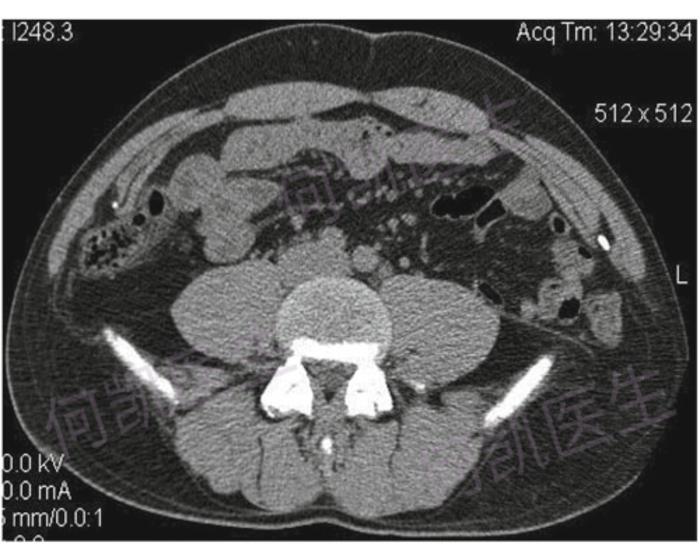 腰疝是指腹腔的内脏或者脂肪从腰部(身体的12肋与髂嵴之间)突出所形成