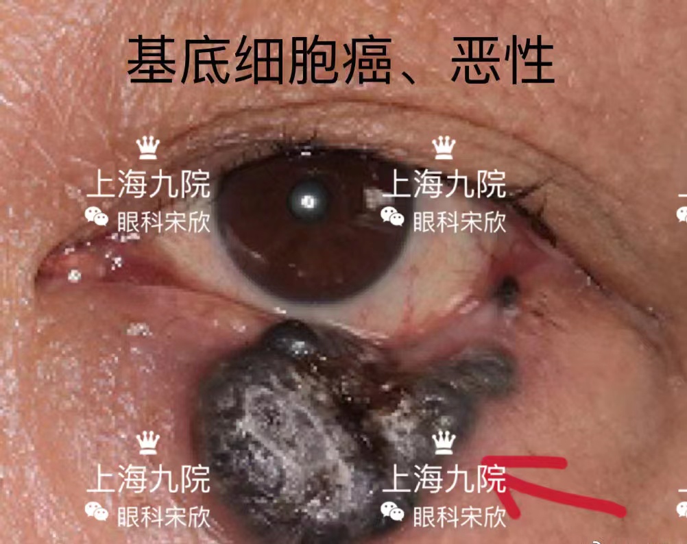 眼睑恶性黑色素瘤图片图片