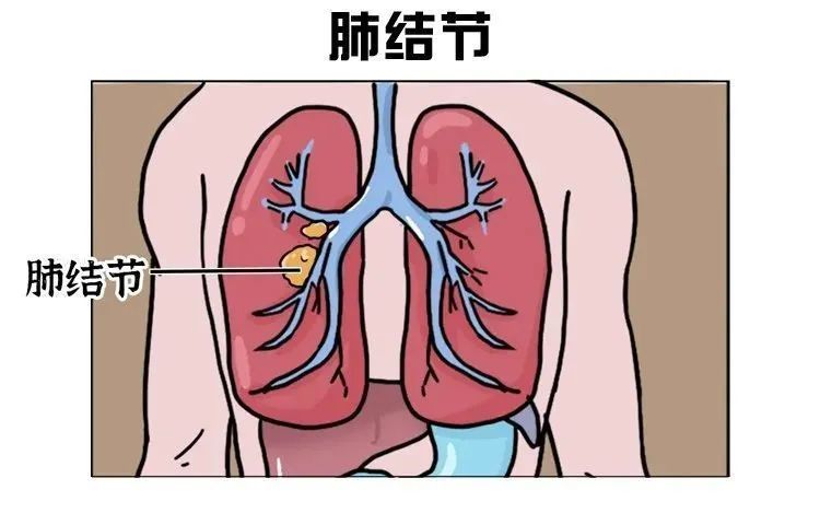 肺部结节