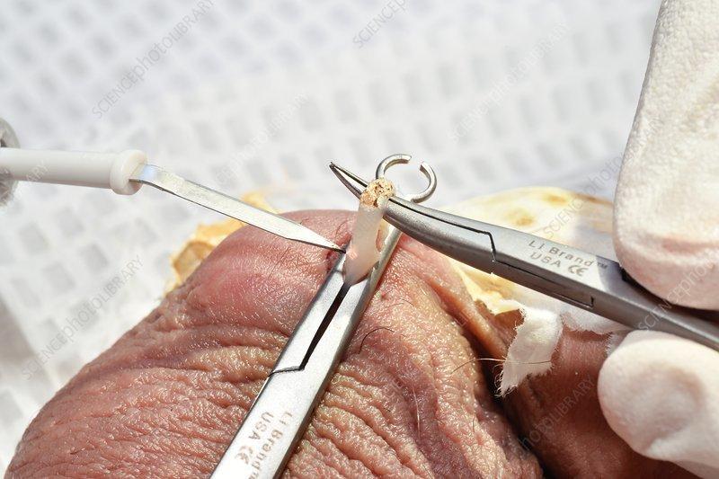 男性绝育  输精管结扎手术,你准备好了吗?