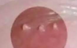外阴长小疙瘩还有另外的可能:一是由人乳头瘤病毒感染引起的尖锐湿疣