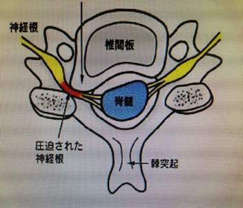 常见脊柱疾病的自检自查神经根型颈椎病