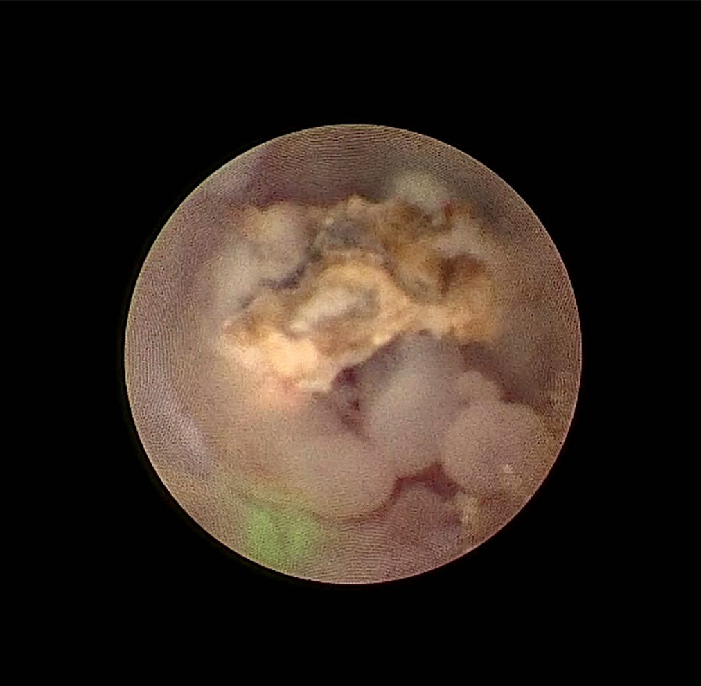 术中见输尿管结石被息肉包裹,形成完全梗阻,此类患者虽经钬激光碎石