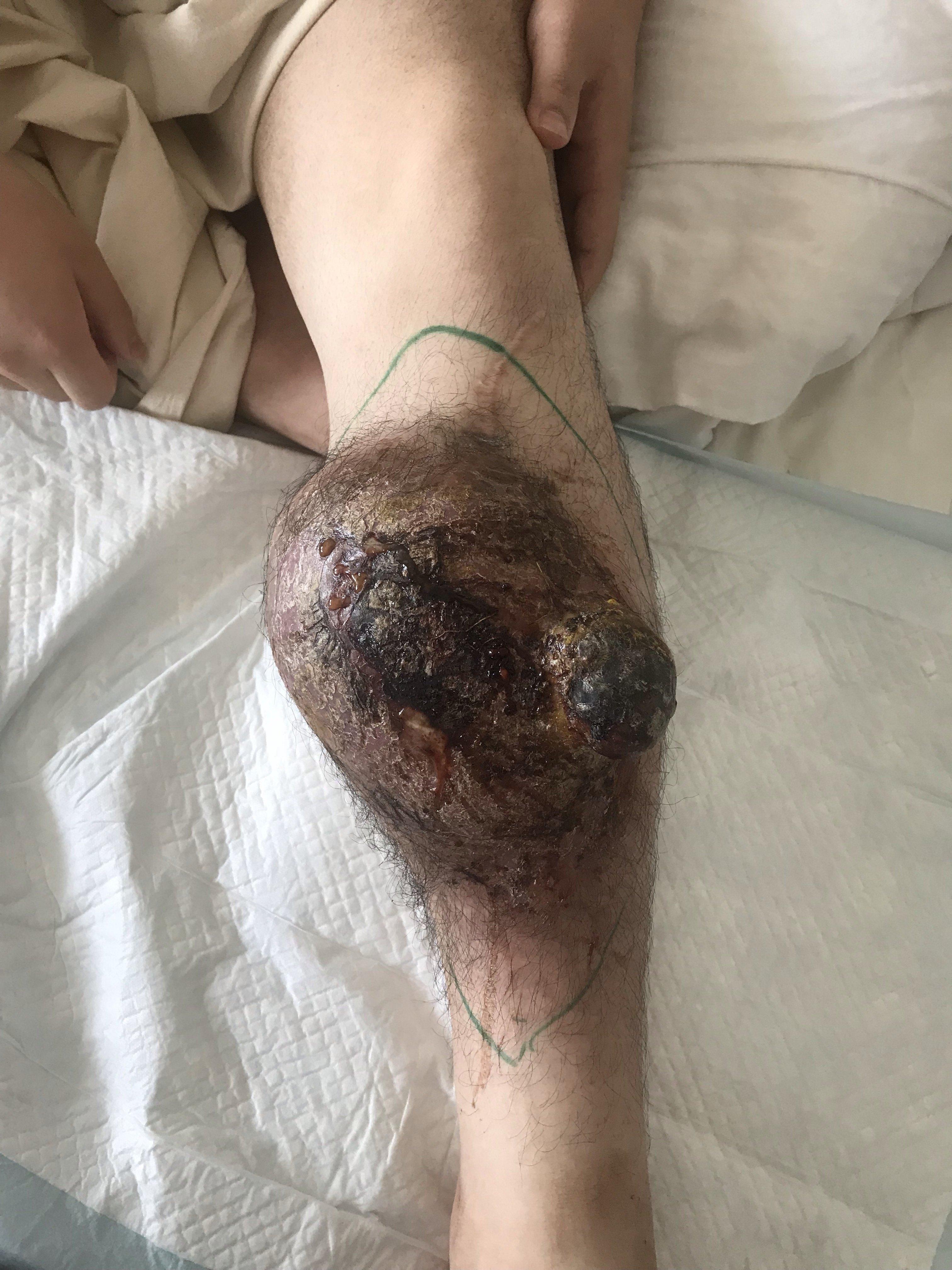 关于肿瘤人工关节再次手术的问题