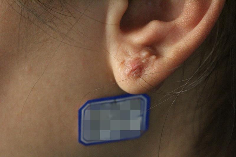 邓娟主任小课堂之瘢痕疙瘩小耳洞变大肉球