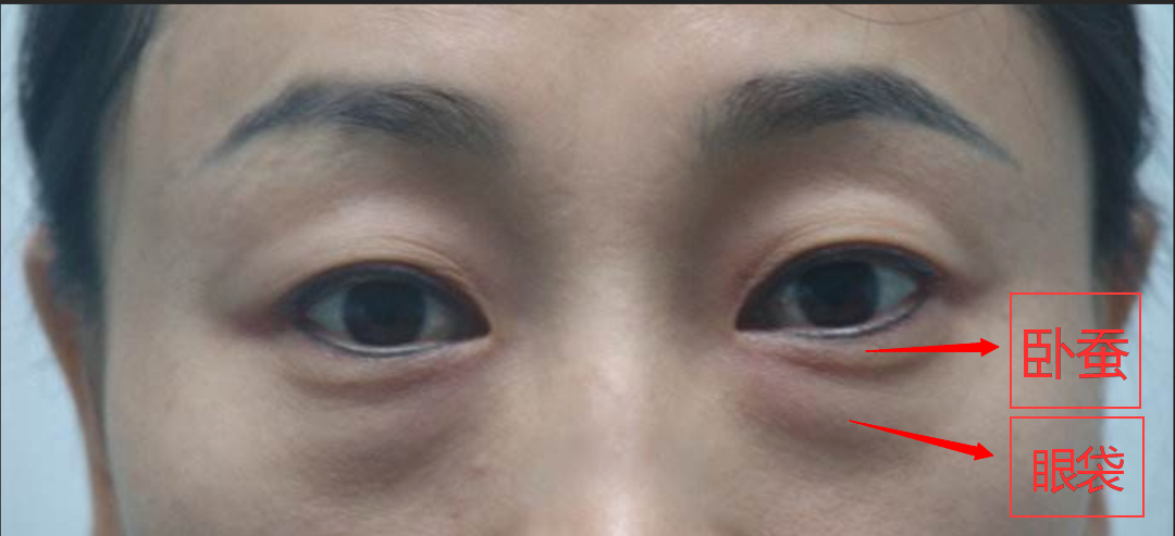 和打瘦脸针是一个道理,通过肉毒素对下睑眼轮匝注射,使肥厚的眼轮匝肌