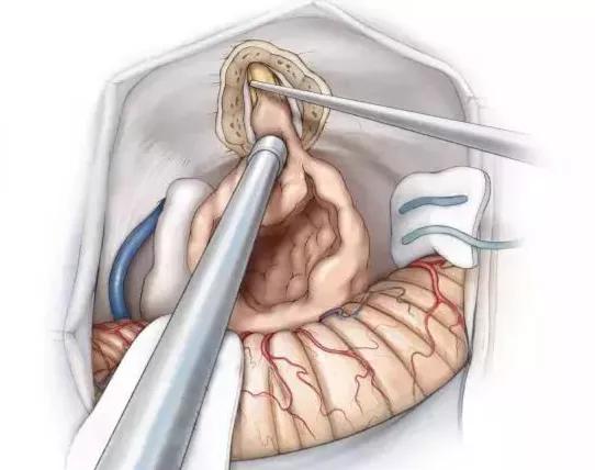 只闻其声不解其意耳鸣切莫忽视听神经瘤的可能
