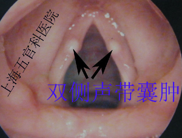 声带囊肿_吴海涛医生文章_复旦大学附属眼耳鼻喉科医院-微医(挂号网)