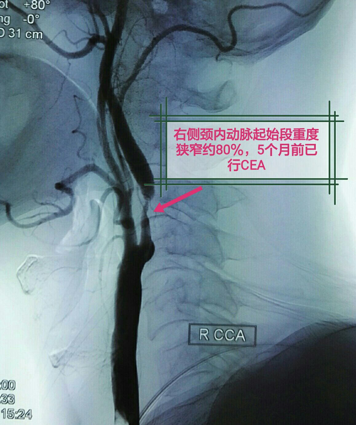 双侧颈动脉内膜剥脱术一例