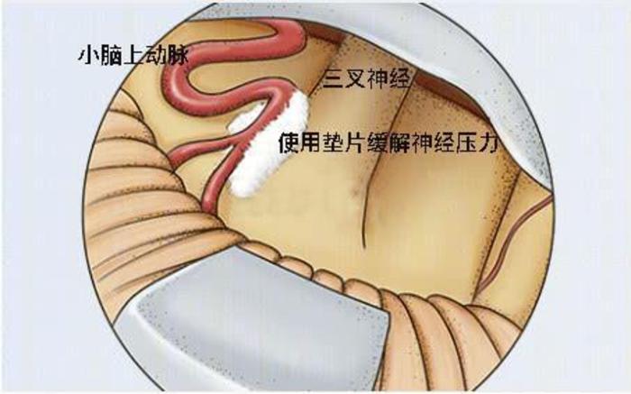 面肌痙攣三叉神經痛的剋星微血管減壓術