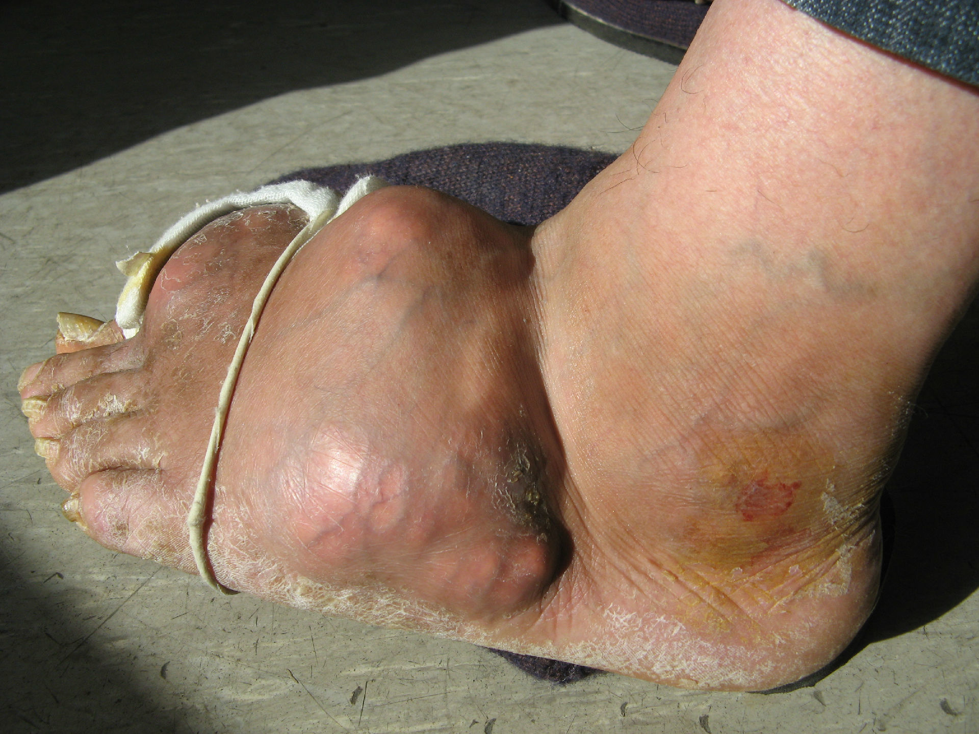 痛风晚期大量尿酸盐结晶形成痛风石可致残:急性发作期不应新加用降血