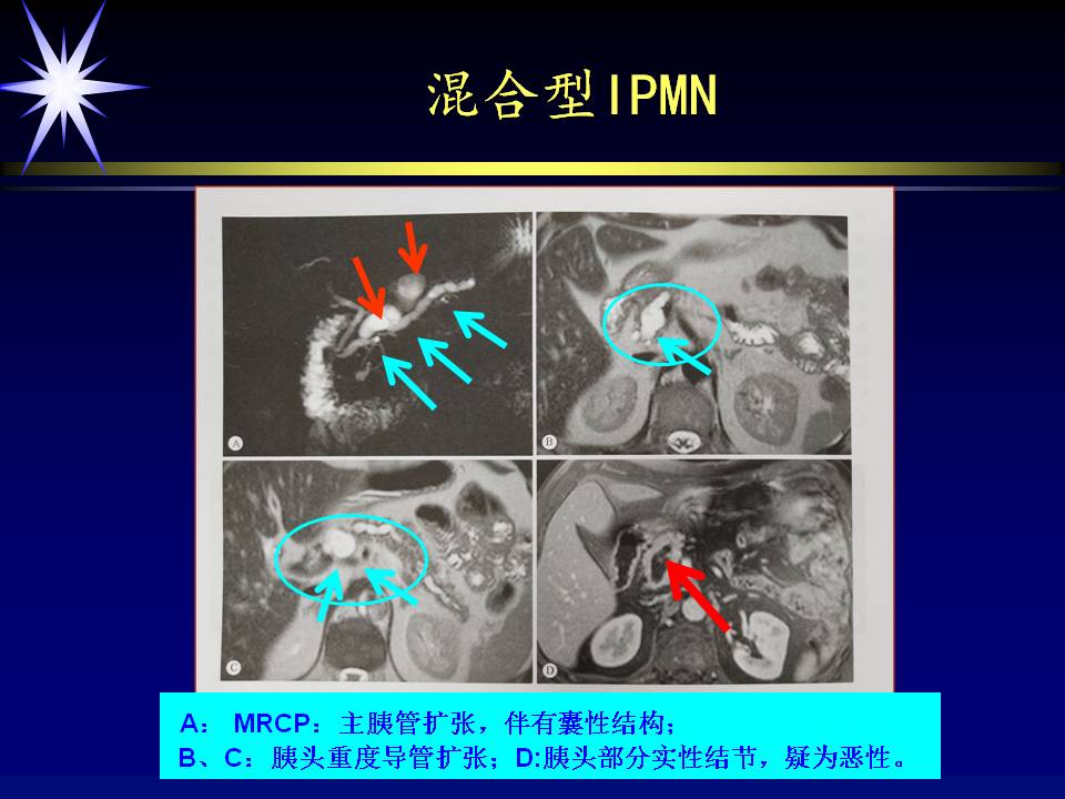 胰管型ipmn图片