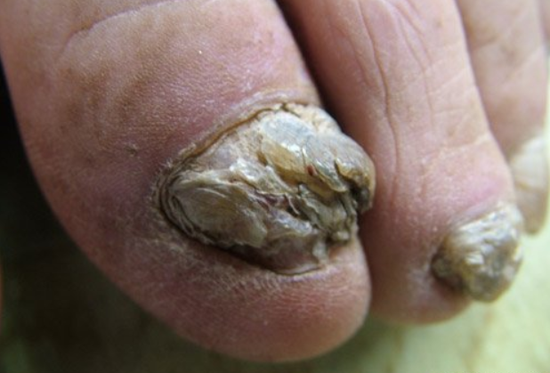 灰指甲(甲癣)可以治愈吗?