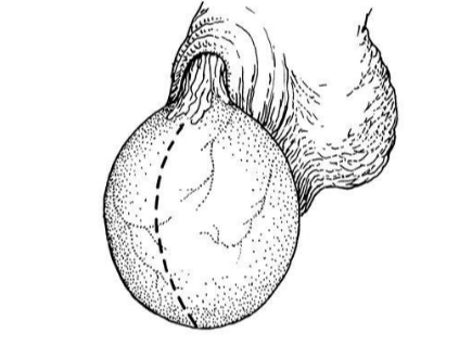 睾丸蚯蚓状图片图片