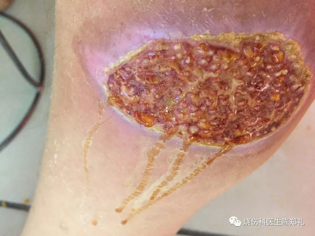 伤口为什么要涂药膏