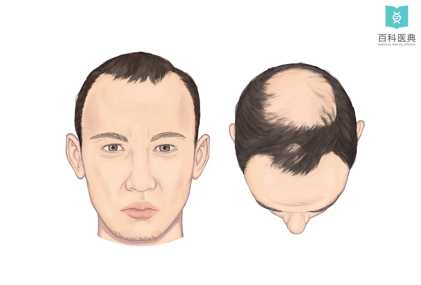 向后退缩,头顶头发逐渐开始脱落;发际线不断后移,前额变高形成"高额"