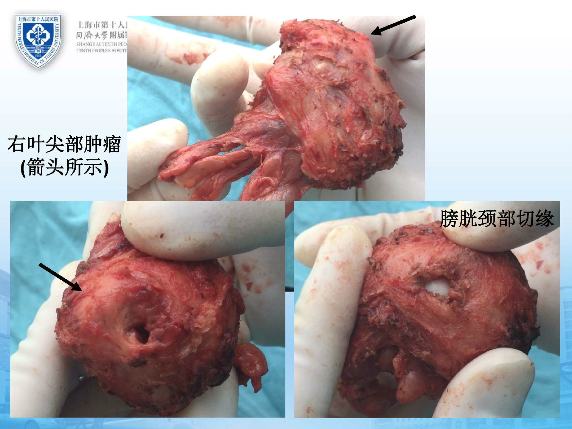采用经腹膜外途径,术中完整切除了前列腺尖部肿瘤,保留了足够长度的膜