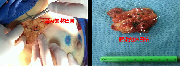 乳癌患者为什么需要进行前哨淋巴结活检 - 微医(挂号网)