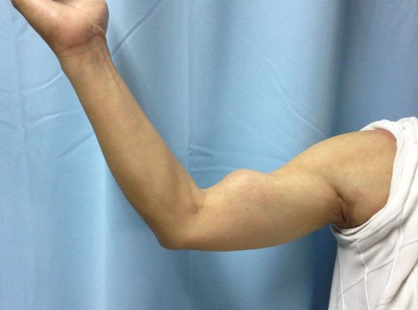 个别患者可能会由于肱二头肌的向远端收缩,引起鼓眼畸形.