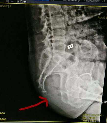 尾骨骨折 尾骨骨折画法