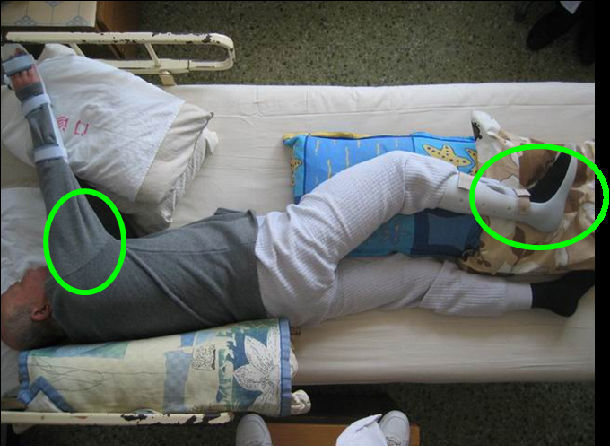 健侧卧位(偏瘫侧在上)手握毛巾卷,放在肚子上 