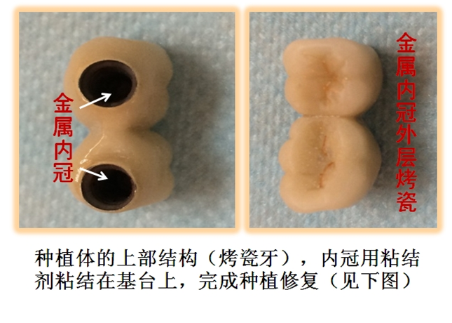 种牙痛吗?什么人可以种牙?种牙使用寿命、费