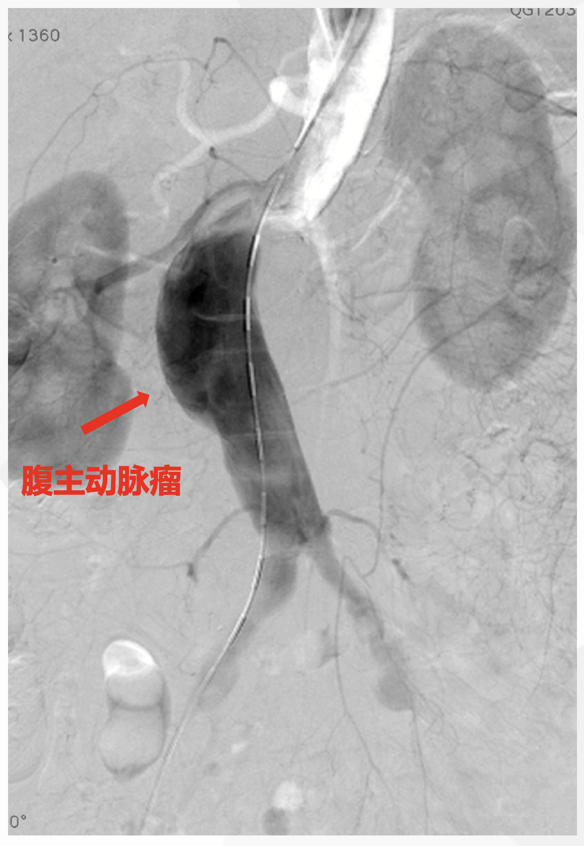 腹部主动脉血管瘤图片