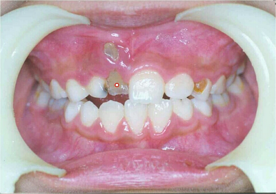 周炎波及恒牙16乳牙根尖周炎引起牙龈瘘管16乳牙根尖周炎将影响恒