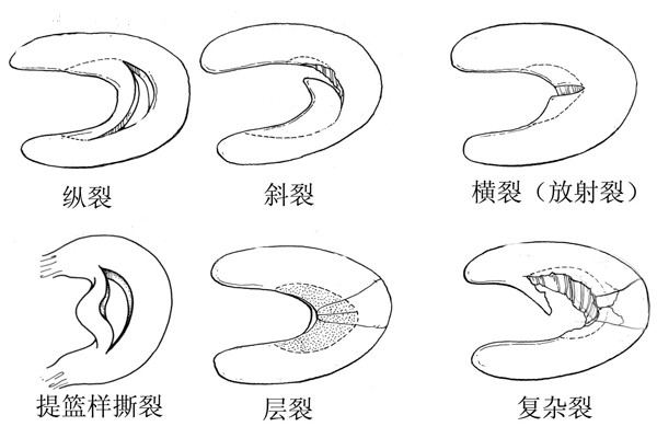 半屈曲,外展位時,身體及股部猛然內旋,內側半月板在股骨髁與脛骨之間