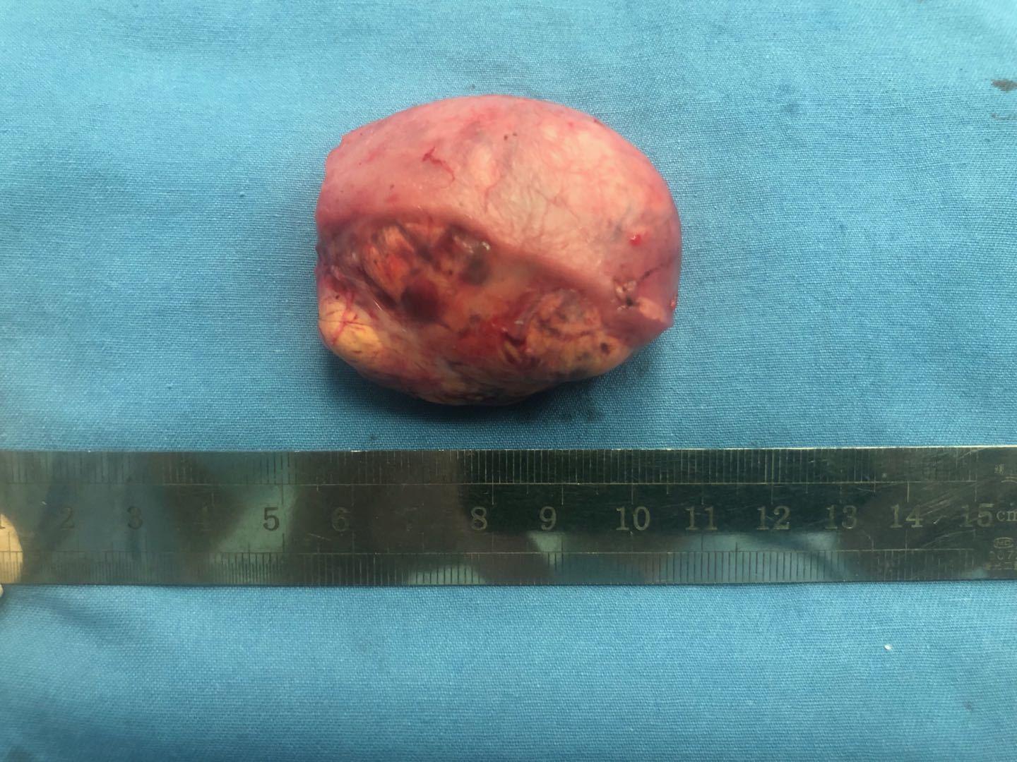 右肾中央型肿瘤5厘米行腹腔镜肾部分切除一例