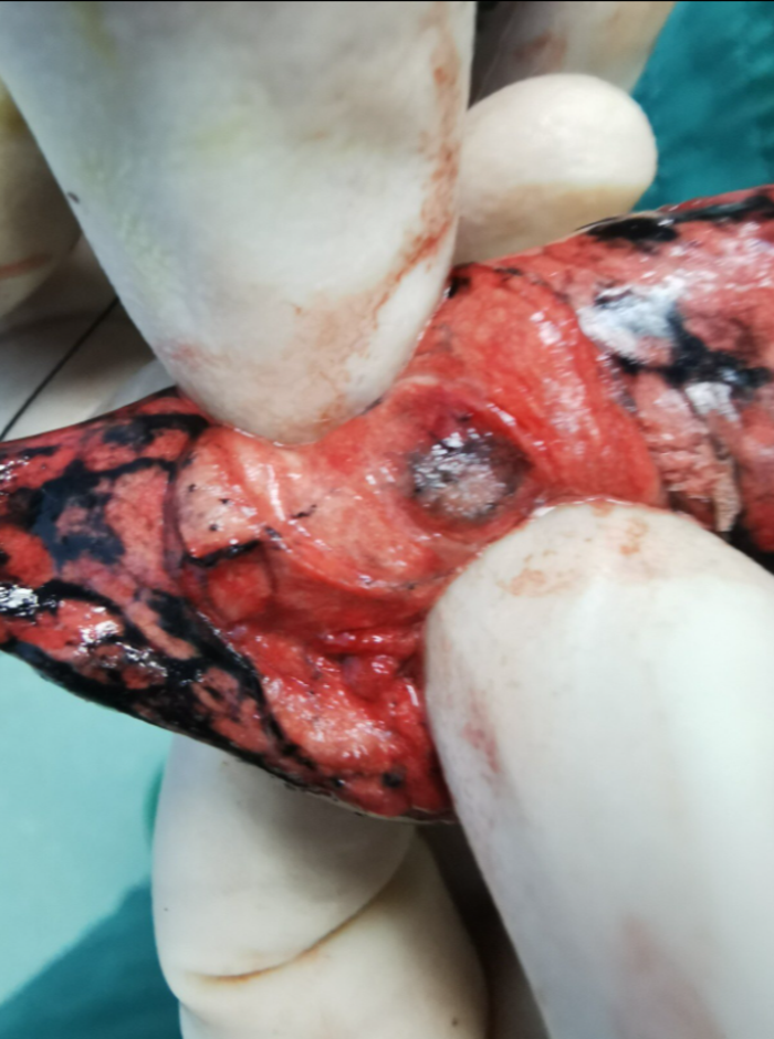 恶行肺部小结节的不同形态