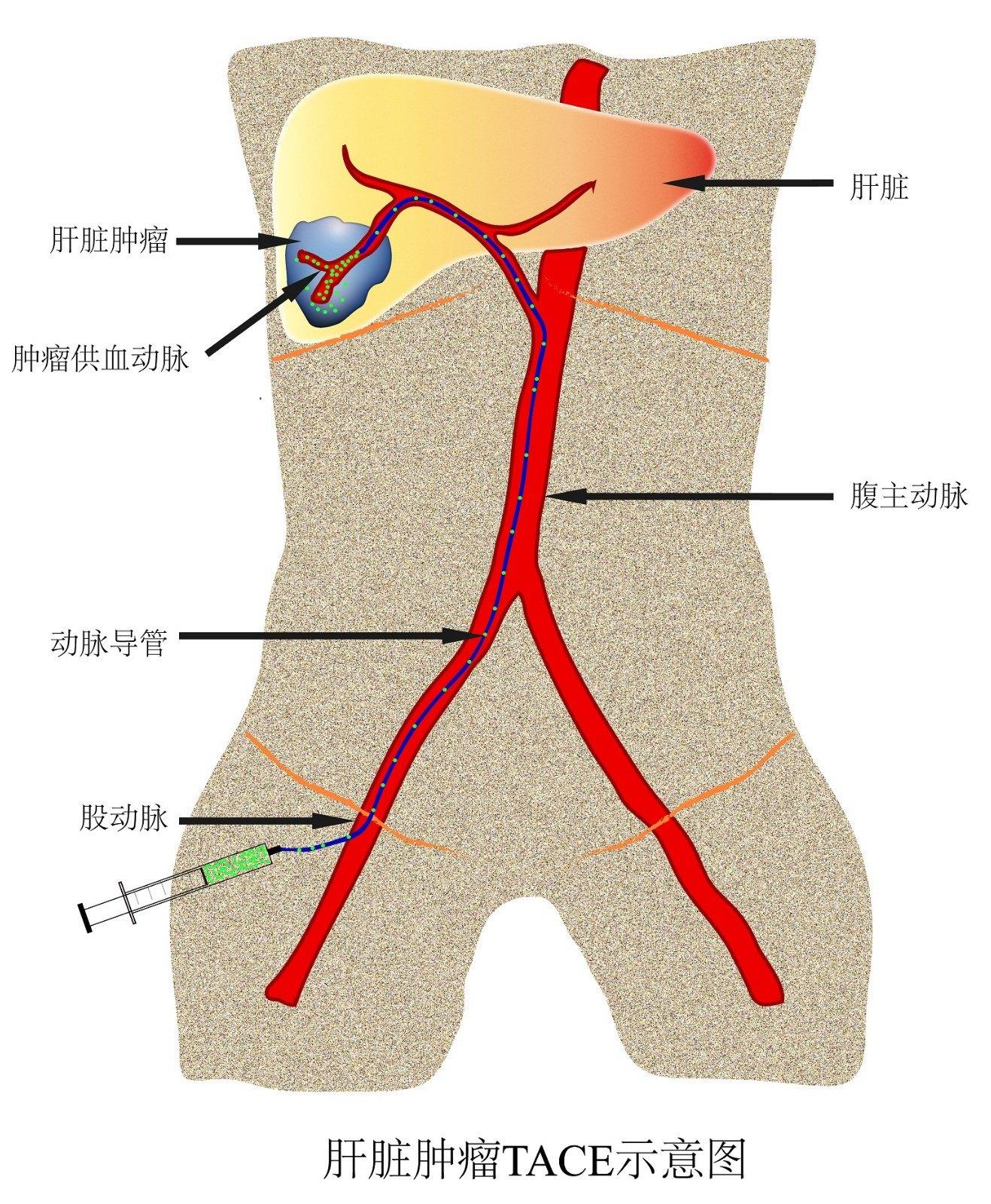 在大腿上局部麻醉,打一个孔进入血管,向上沿着血管的走行找到肝动脉