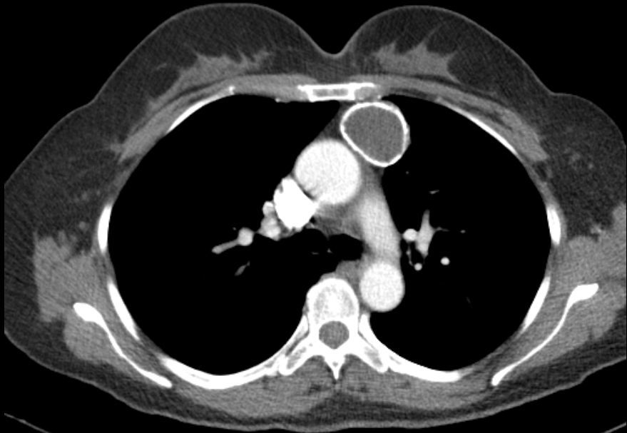 前纵隔结节/前纵隔肿块,胸腺囊肿(thymiccyst)和胸腺瘤如何区别,需要