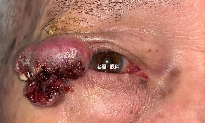 眼睑恶性肿瘤系列之鳞状细胞癌
