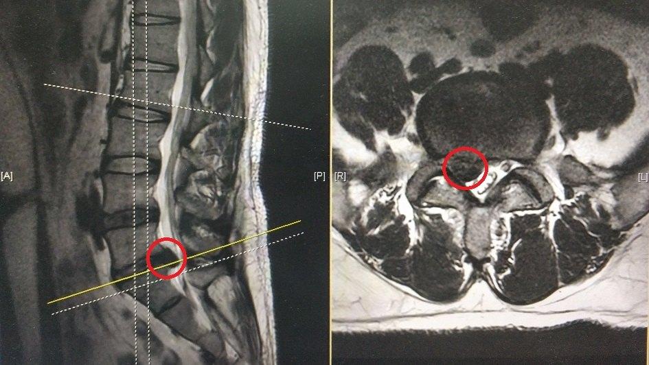 腰椎mri示:l5-s1椎间盘脱出并下游离,神经受压迫严重(下图中红色圈