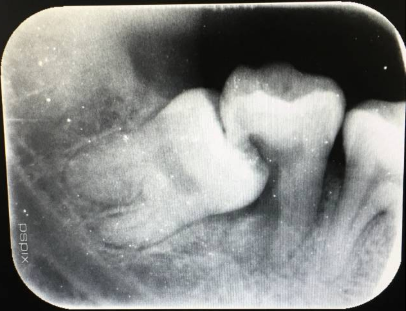 智齿拔还是不拔智慧人也有自己的小忧桑