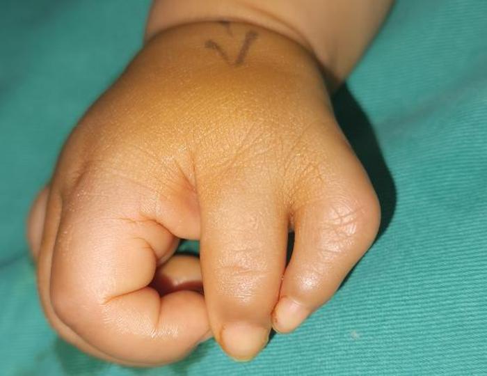 一岁多的小男孩wasselⅤ型复拇指畸形手术