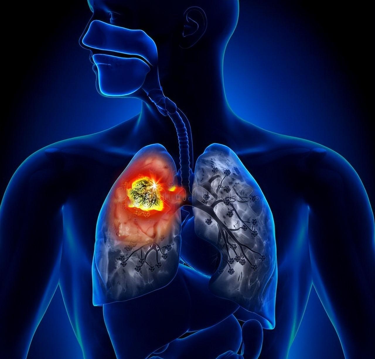 15个常见的恶性肺结节影像特征 | 建议收藏|肺癌|病灶|胸膜_新浪新闻