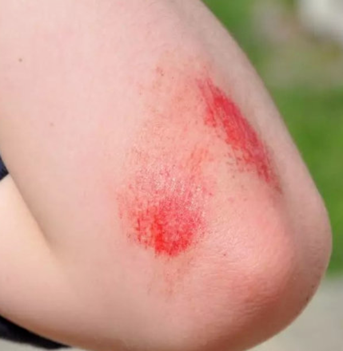 缝不缝针取决于伤口的深度,如果属于擦伤或是单纯表皮损伤可以不缝针