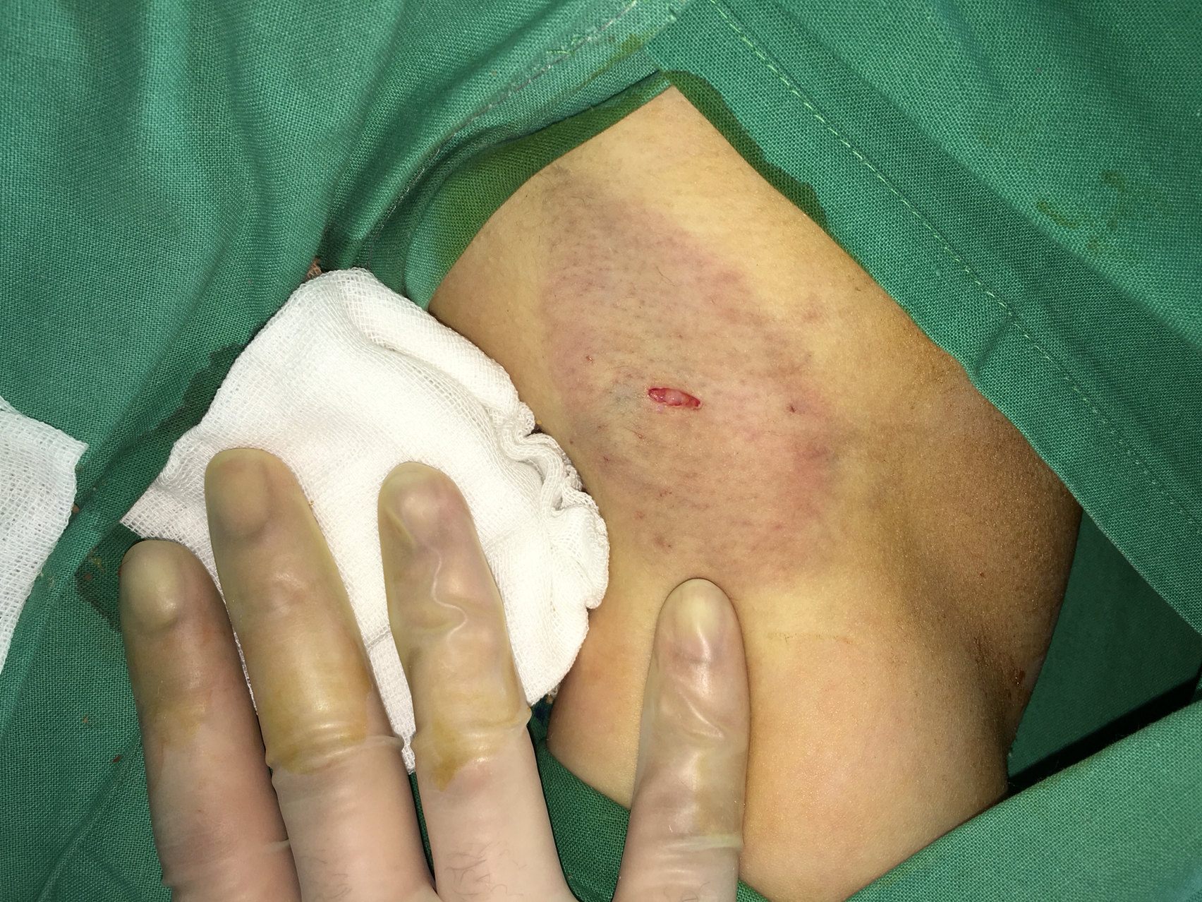 腋臭手术成果九院造就的艺术品