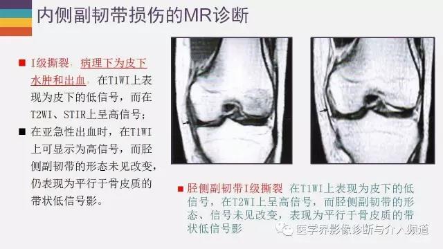 检查技术韧带损伤膝关节内侧副韧带的磁共振检查