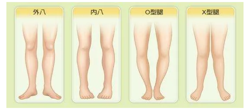 孩子走路姿势"难看"-需要看医生吗?