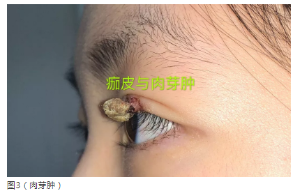 肉芽肿(图3,4),皮肤溃破后可以产生瘢痕,皮肤缺损,眼睑外翻等畸形(图5