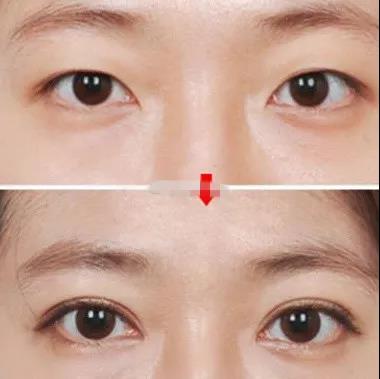韩式3点双眼皮图片