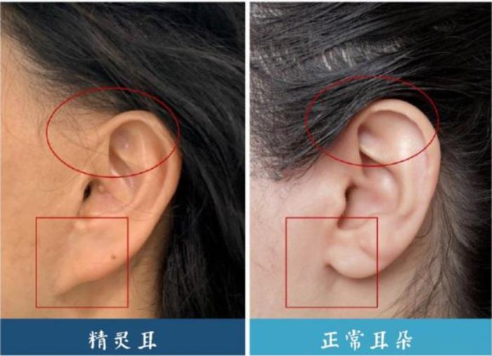 做大拉皮手术,我的耳朵"变形"了? - 微医(挂号网)