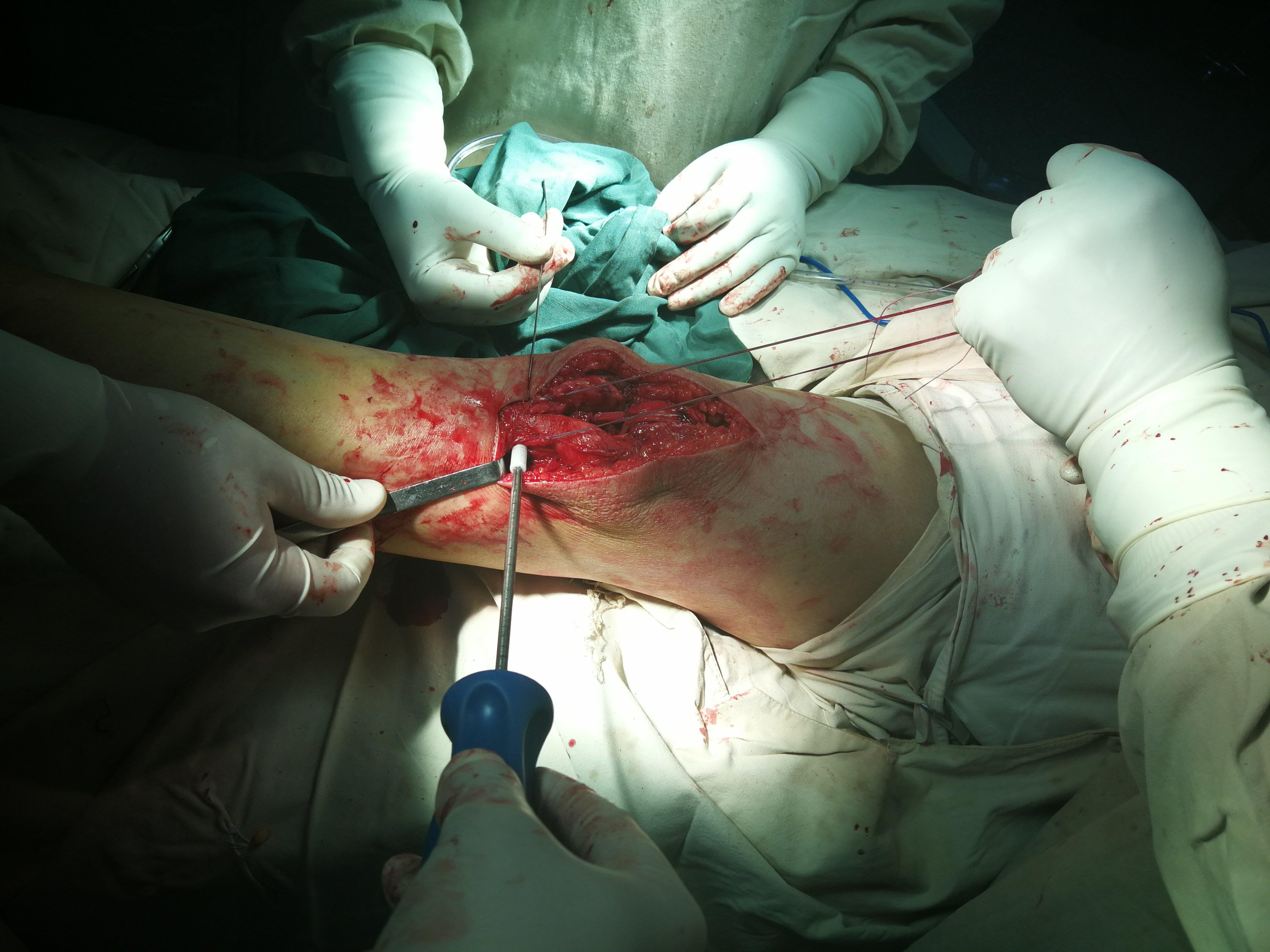 膝关节髌韧带陈旧损伤断裂自体肌腱重建术