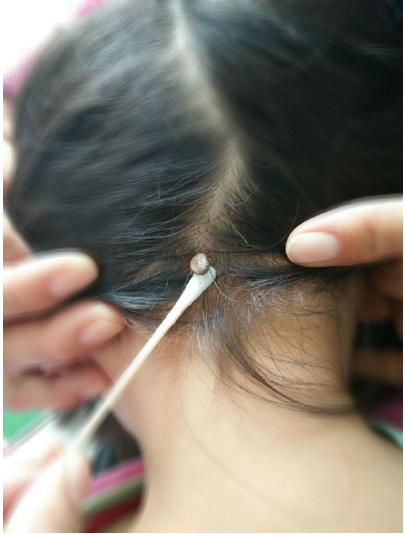 一例蜱虫叮咬病例 拔出后口器遗留皮内_吴蓓玲医生文章_浙江省中医院